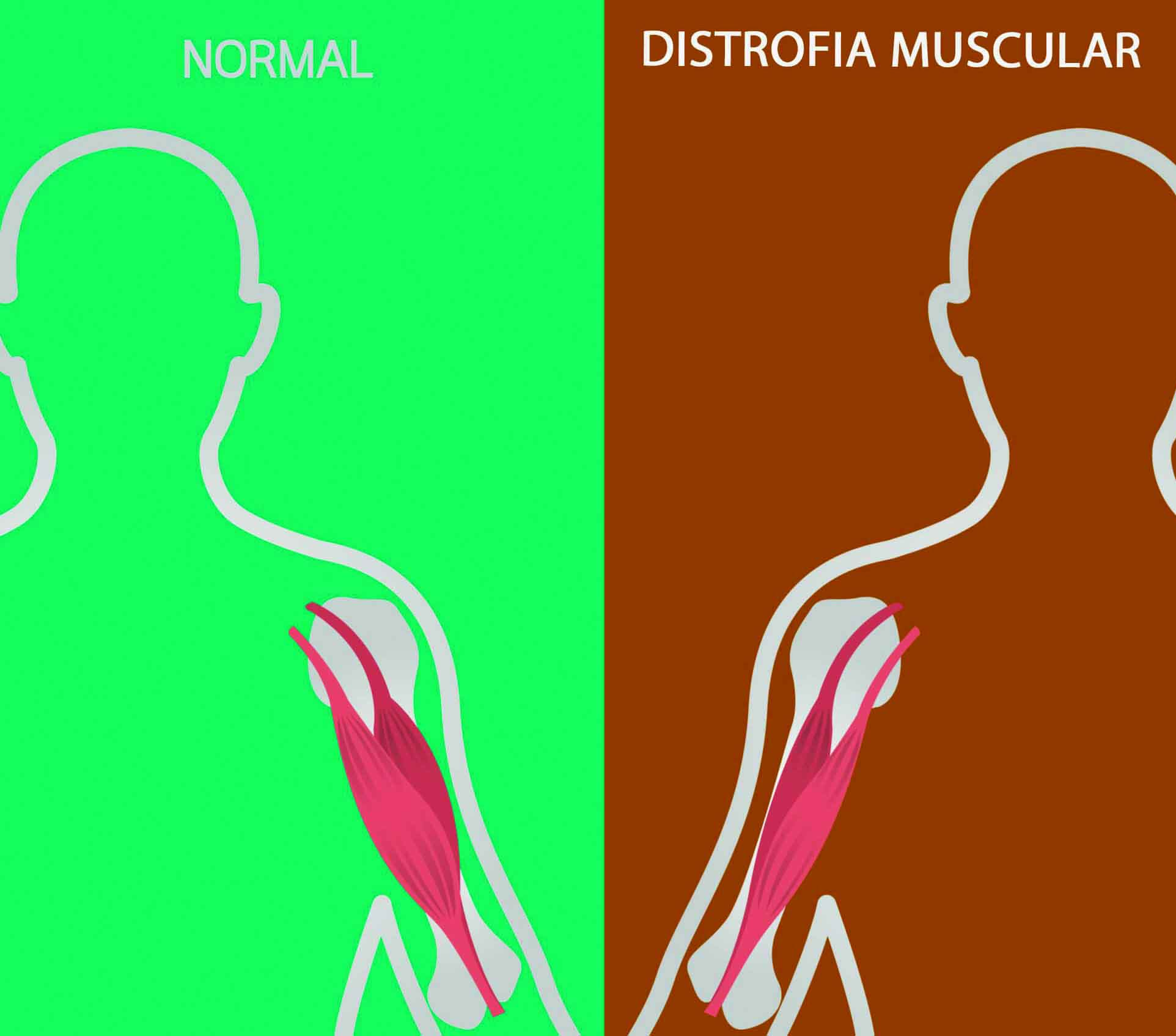 Las distrofias musculares en la literatura, el cine y la televisión.